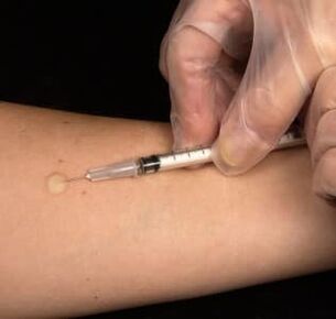 Injection sous-cutanée de testostérone